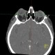 Endocrine orbitopathy, exophthalmus: CT - Computed tomography